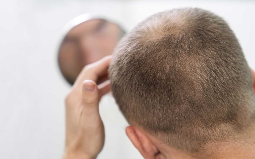 Natural DHT Blockers for Male Pattern Hair Loss: What Works and Why